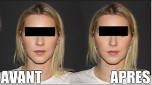 rhinoplastie avant et après