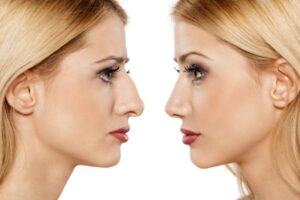 Types rhinoplastie Turquie