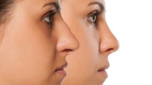 rhinoplastie Turquie