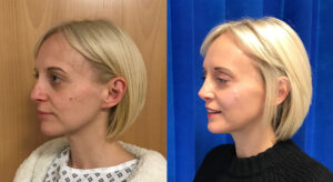 rhinoplastie révision