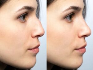 types rhinoplastie Turquie