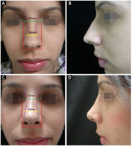 Rhinoplastie spreader flaps