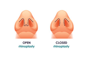 techniques rhinoplastie ouverte et fermeé