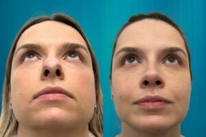 rhinoplastie pîezoelectrique