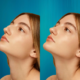 rhinoplastie