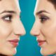 rhinoplastie physionomie