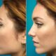 rhinoplastie esthétique et fonctionelle