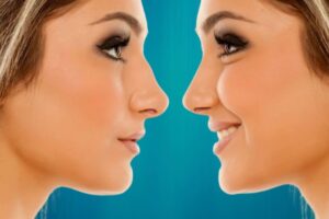 rhinoplastie medicale