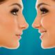 rhinoplastie medicale